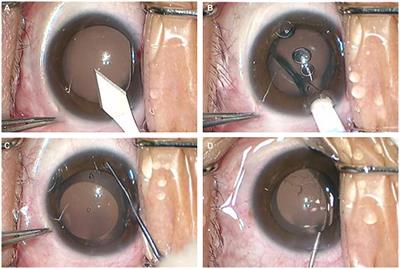 Causes and management strategies for elevated intraocular pressure after implantable collamer lens implantation